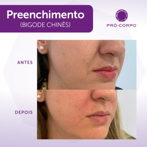 Preenchimento Bigode Chines Fotos  Antes e Depois
